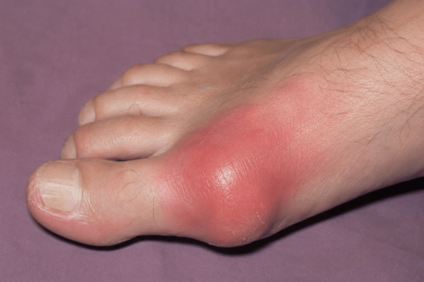 Gout Prevention